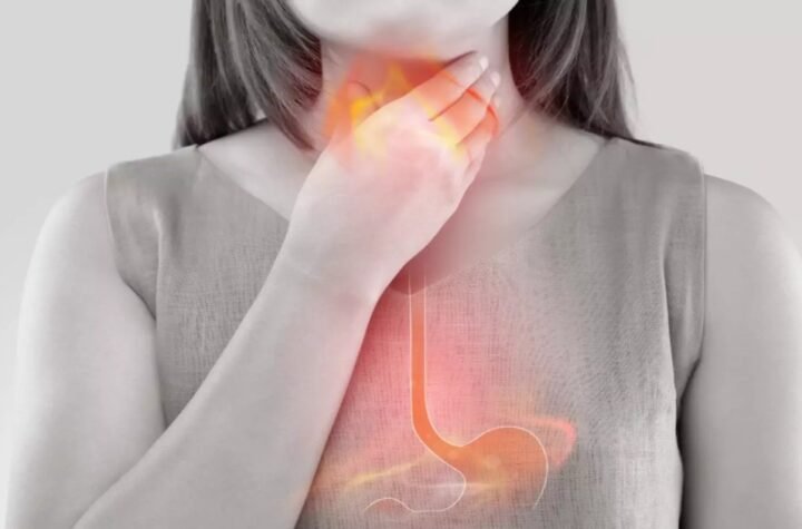 A sensação de enfartamento e de ardor no peito, como se estivesse queimando, não passa? pode ser refluxo gastroesofágico é o retorno involuntário e repetitivo do conteúdo do estômago para o esôfago.